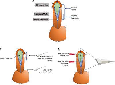 Ultrasonographic Evaluation of the Hypospadiac Penis in Children